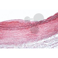 Ateroskleróza u člověka