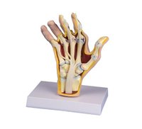 Model ruky s revmatoidní artritidou
