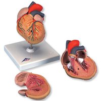 Klasický model srdce s hypertrofií levé komory, 2 části