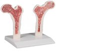 Osteoporóza stehenní kosti - NOVINKA!
